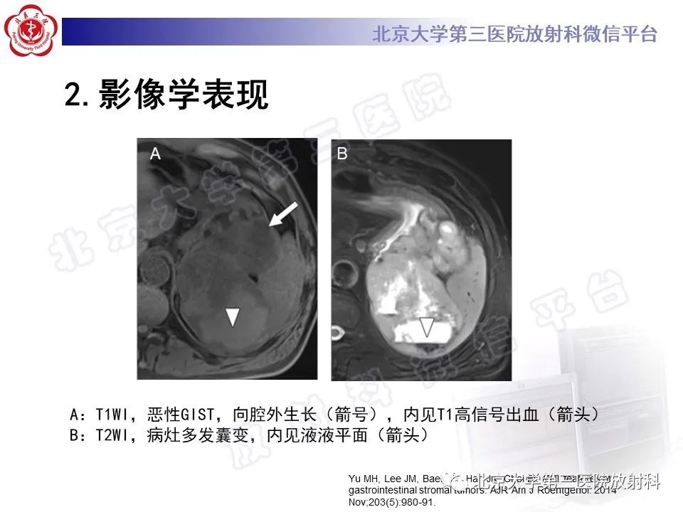 【PPT】胃肠道间质瘤-20