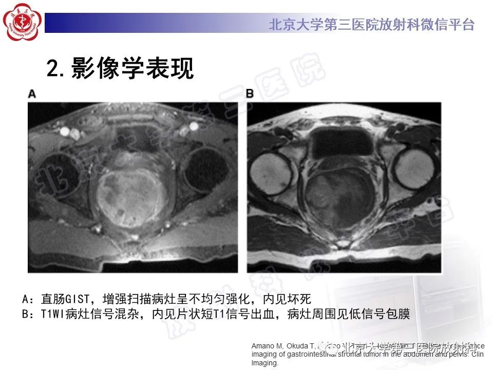 【PPT】胃肠道间质瘤-21