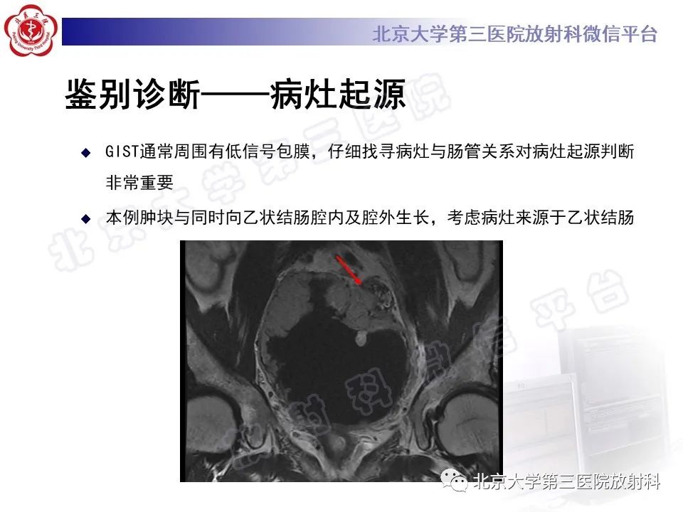 【PPT】胃肠道间质瘤-23