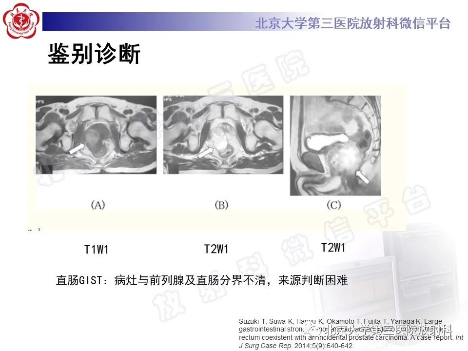 【PPT】胃肠道间质瘤-25