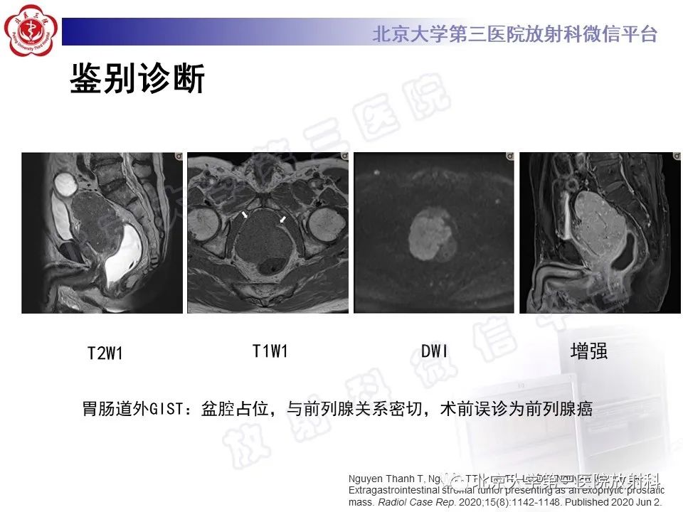 【PPT】胃肠道间质瘤-24