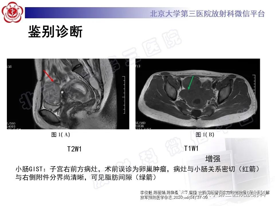 【PPT】胃肠道间质瘤-26