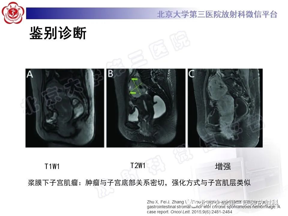 【PPT】胃肠道间质瘤-27