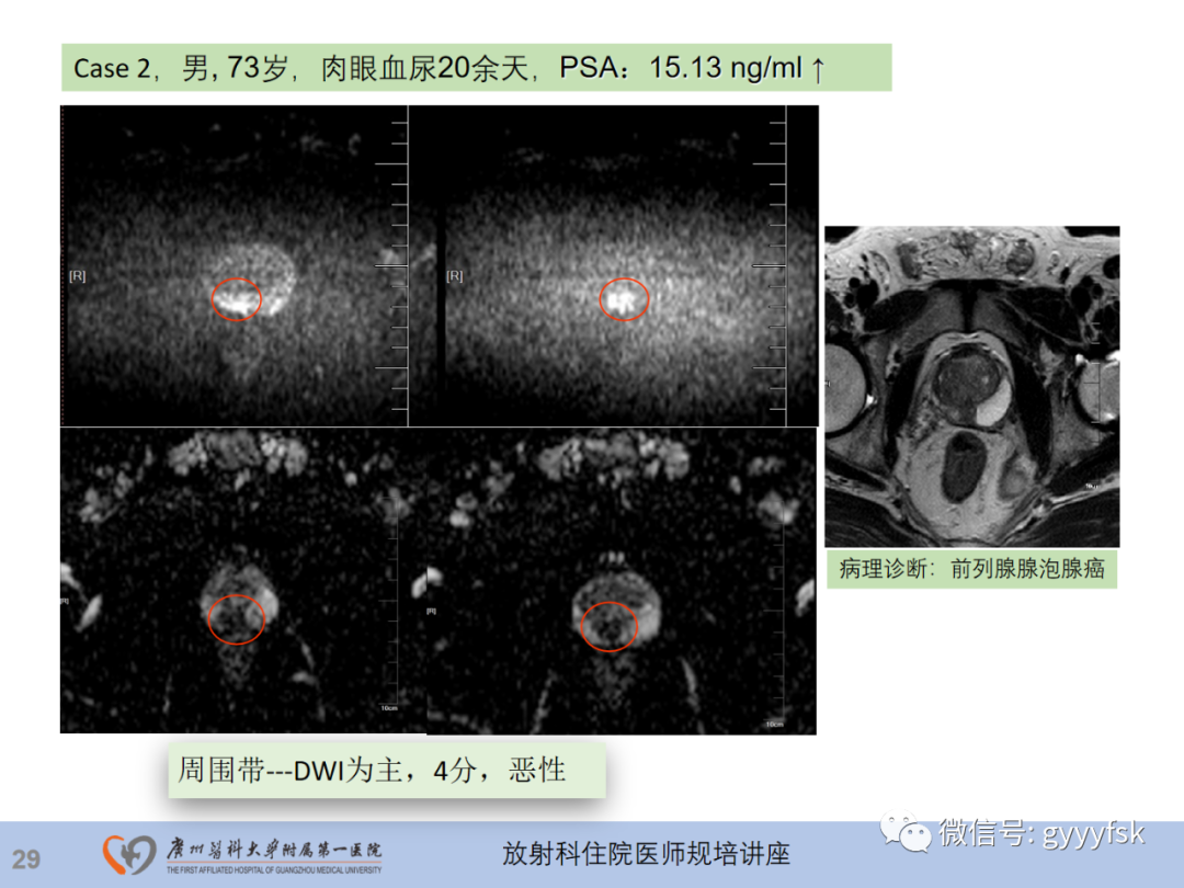 【PPT】前列腺癌的MR扫描规范及精准诊断-30