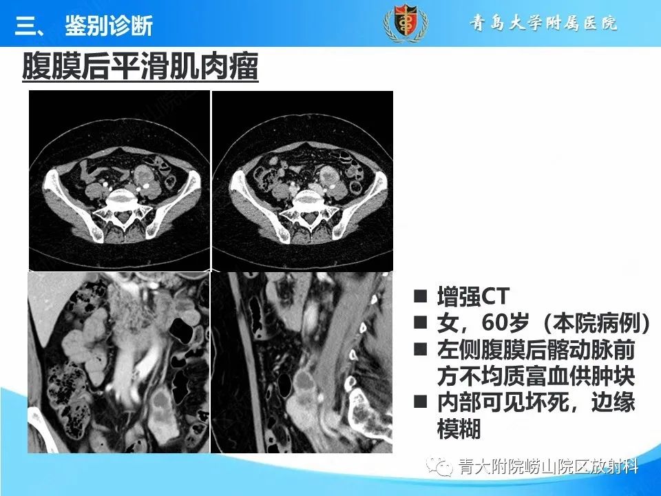 【病例】腹膜后副神经节瘤1例CT影像-45