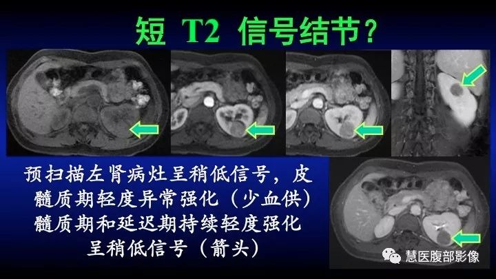 【PPT】肾脏短T2局灶病变MRI表现与鉴别诊断思路-28