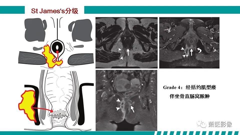 【PPT】肛管及肛周区域病变MRI影像特征-28