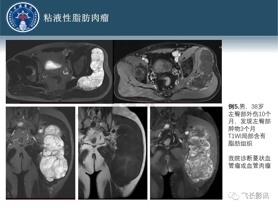 【病例】腹膜后去分化脂肪肉瘤 VS 高分化脂肪肉瘤-29