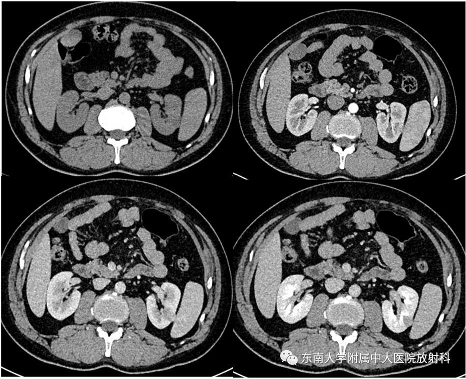 【PPT】肾透明细胞癌-1
