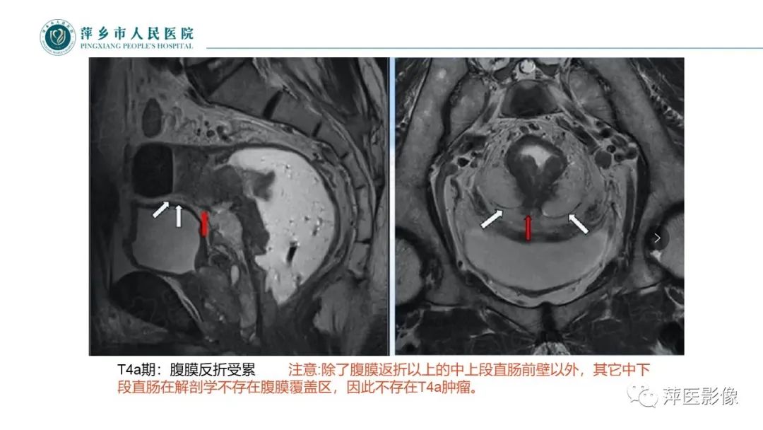【PPT】直肠癌MR分期-36