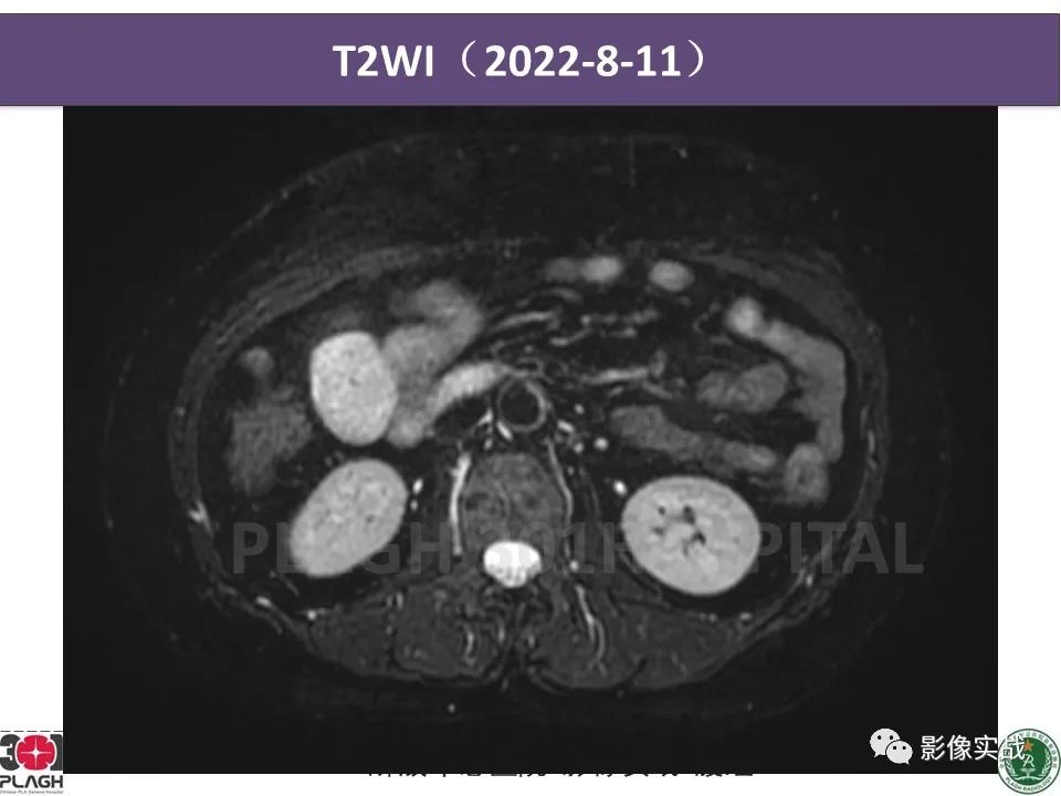 【病例】小肠间质瘤1例CT影像-5