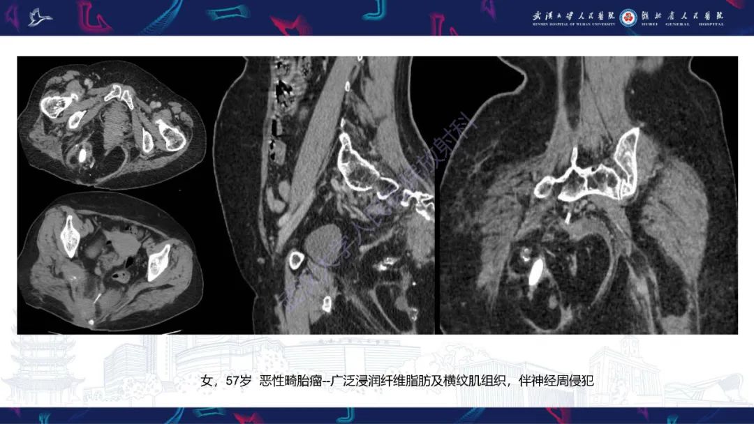 【PPT】盆腹腔巨大占位性病变影像诊断-51