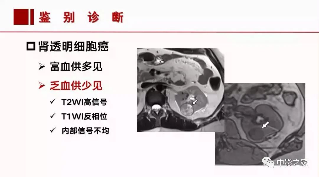 【PPT】肾嫌色细胞癌影像诊断、鉴别、分级与预后评估-32