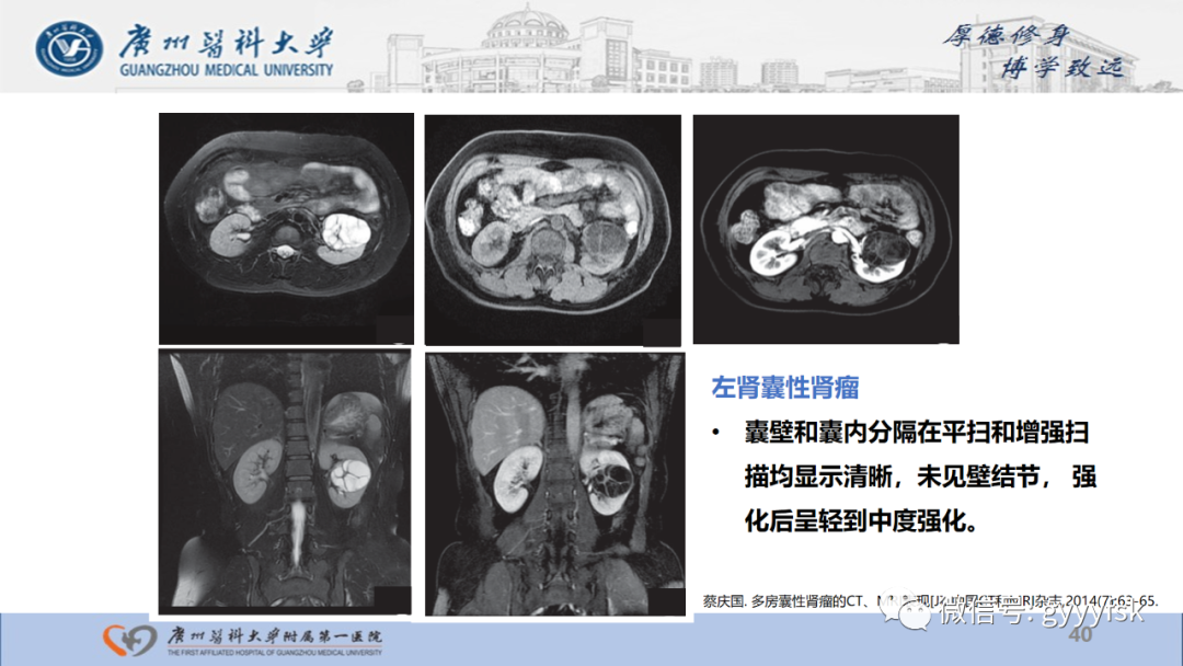【PPT】肾少见肿瘤影像诊断的文献汇报-40