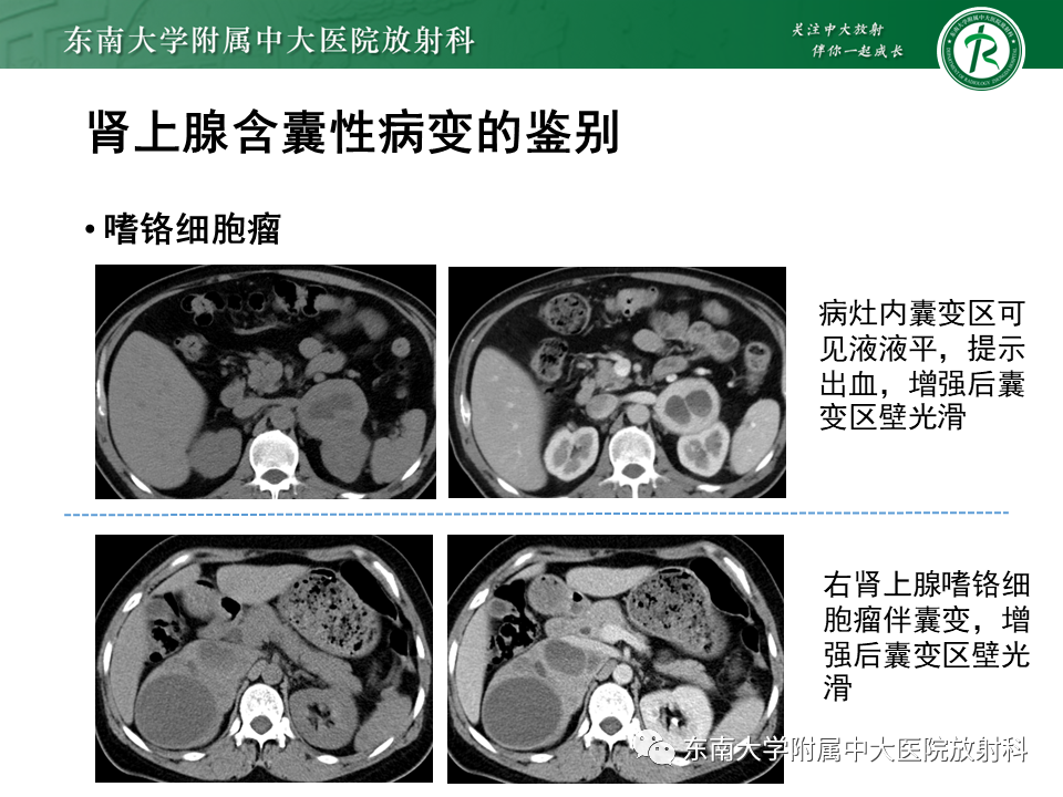 【PPT】肾上腺占位病例随访-25