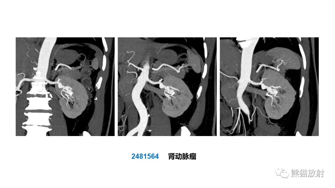 【PPT】肾窦病变影像诊断思路-31