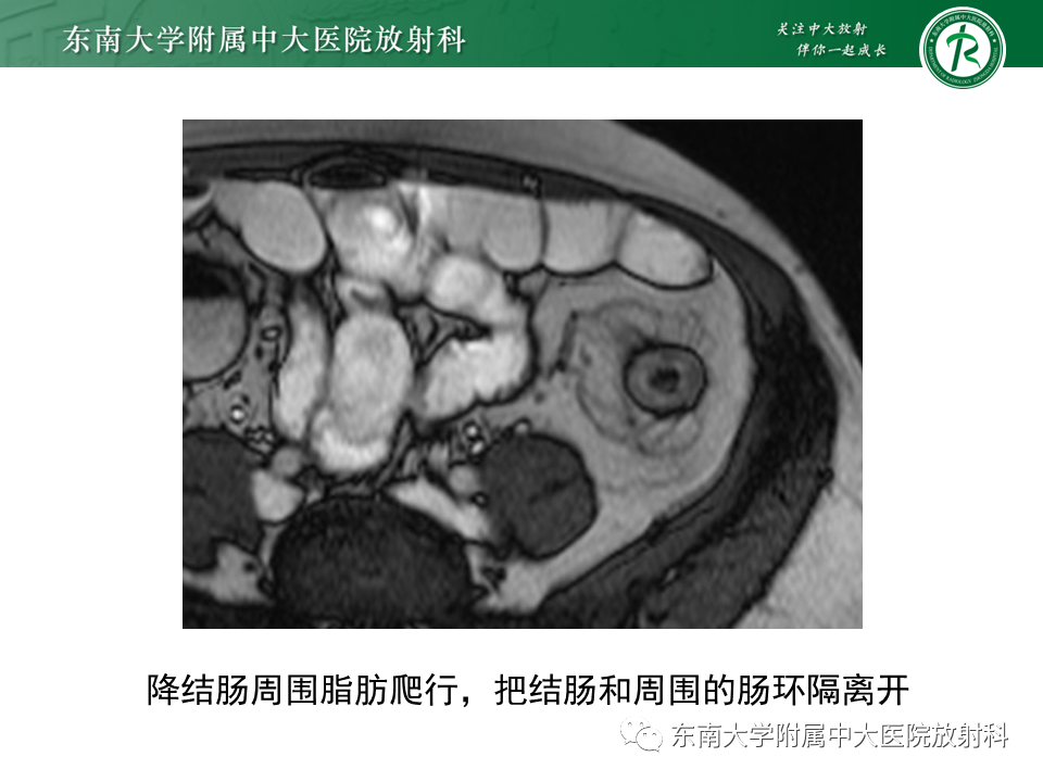 【PPT】克罗恩（Crohn’s）病-33