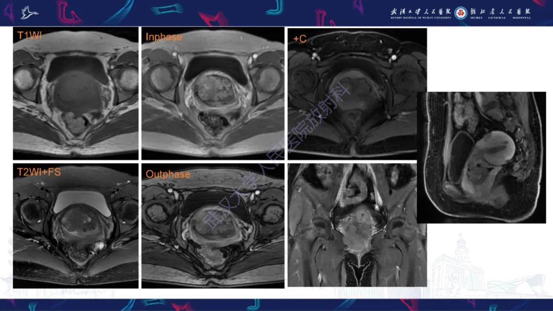 【PPT】阴道髓系肉瘤影像诊断-5