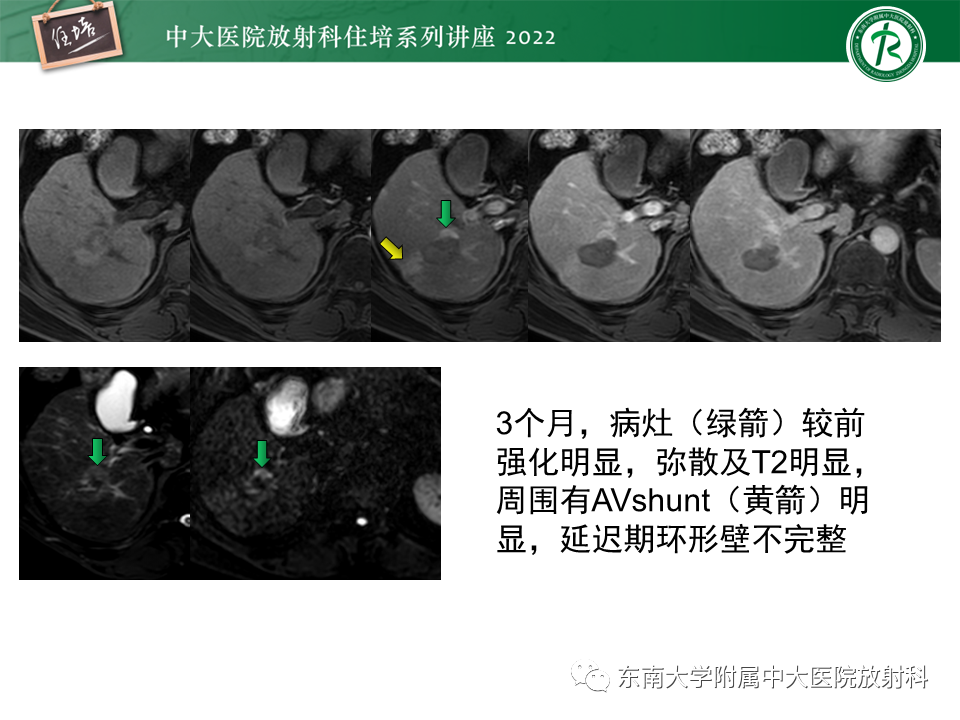 【PPT】肝癌介入治疗后的磁共振评估-26