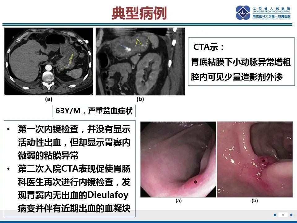 【PPT】胃恒径动脉综合征-31
