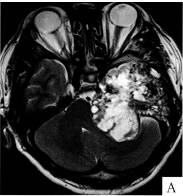 三叉神经鞘瘤1例MR影像表现