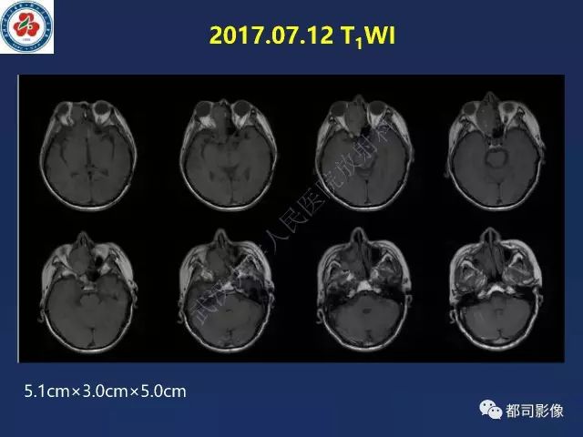 【PPT】鼻腔鼻窦转移瘤1例影像诊断