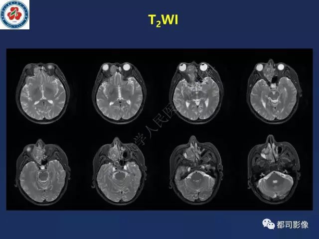 【PPT】鼻腔鼻窦转移瘤1例影像诊断
