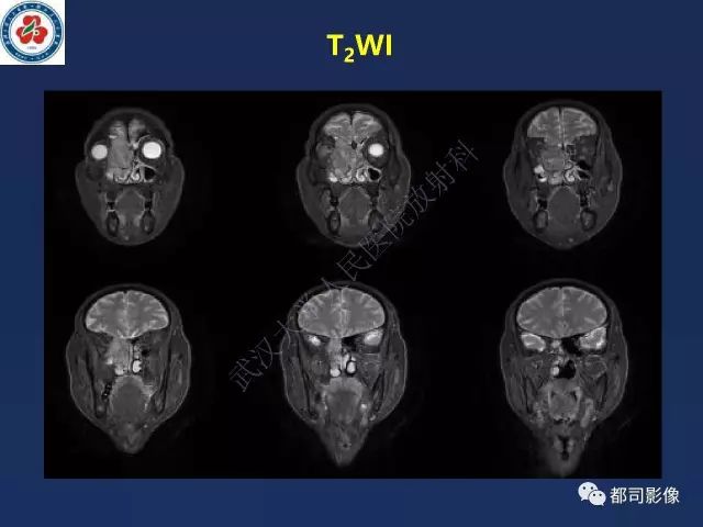 【PPT】鼻腔鼻窦转移瘤1例影像诊断