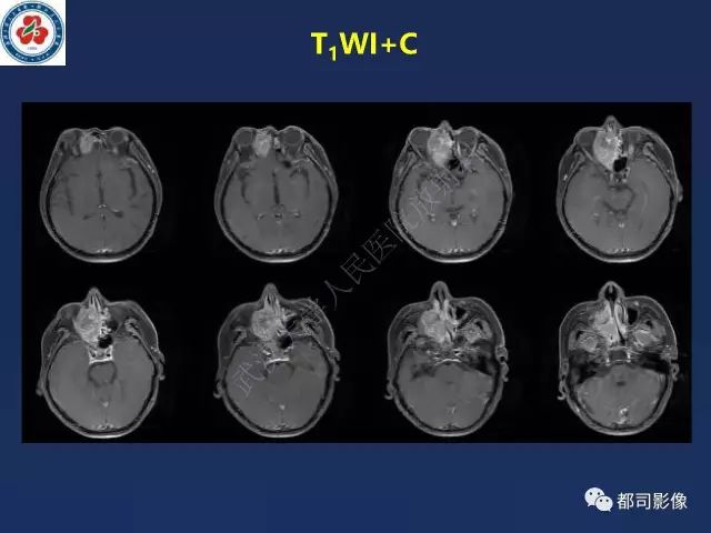 【PPT】鼻腔鼻窦转移瘤1例影像诊断