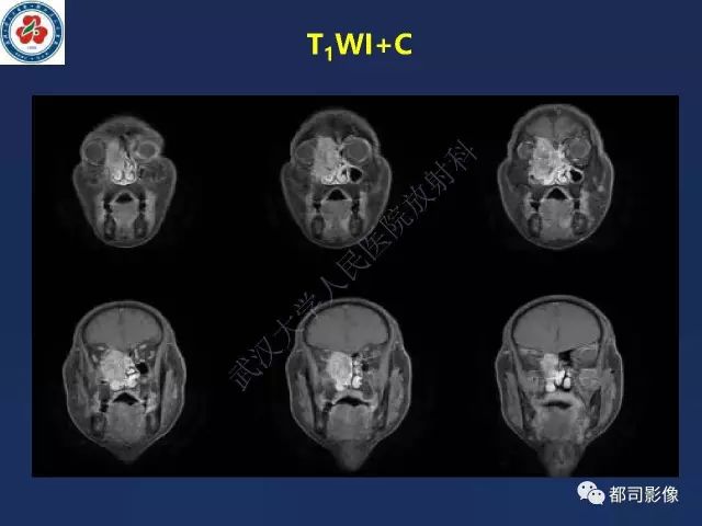 【PPT】鼻腔鼻窦转移瘤1例影像诊断