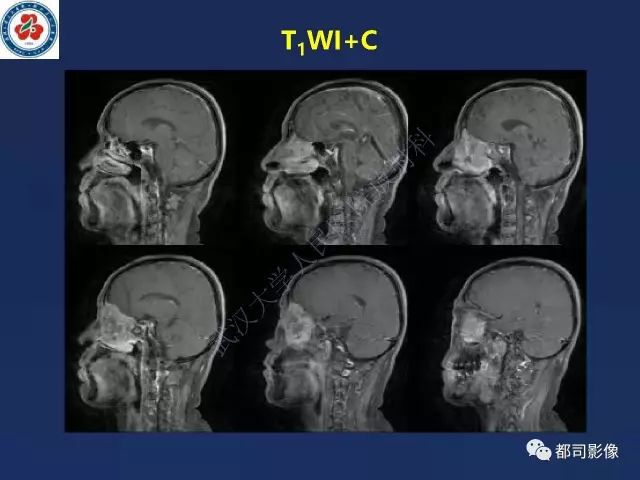【PPT】鼻腔鼻窦转移瘤1例影像诊断