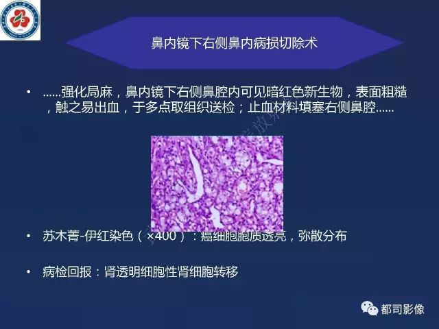 【PPT】鼻腔鼻窦转移瘤1例影像诊断