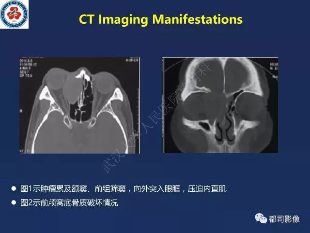 【PPT】鼻腔鼻窦转移瘤1例影像诊断