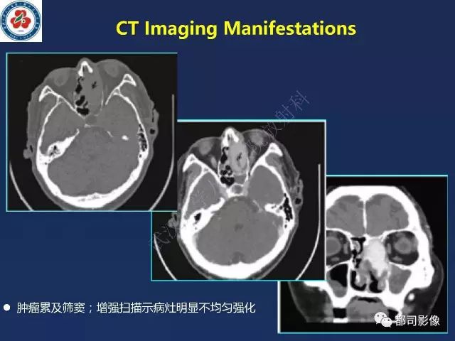 【PPT】鼻腔鼻窦转移瘤1例影像诊断