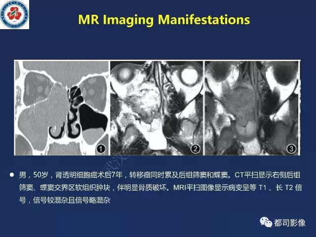 【PPT】鼻腔鼻窦转移瘤1例影像诊断