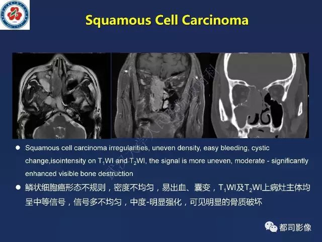 【PPT】鼻腔鼻窦转移瘤1例影像诊断