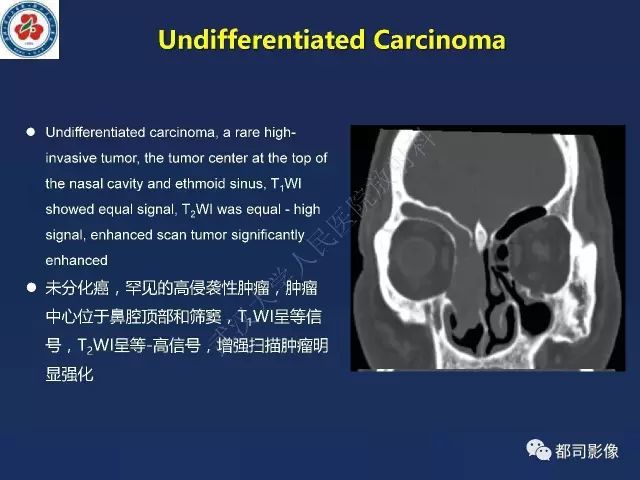 【PPT】鼻腔鼻窦转移瘤1例影像诊断