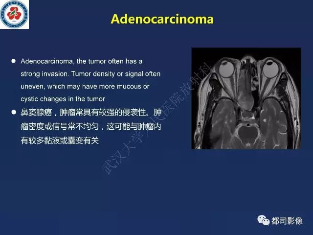 【PPT】鼻腔鼻窦转移瘤1例影像诊断