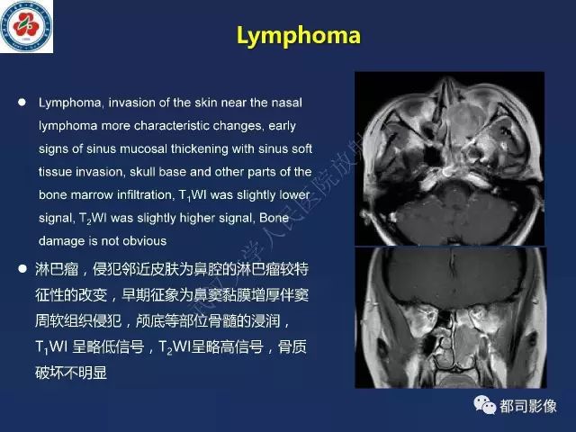 【PPT】鼻腔鼻窦转移瘤1例影像诊断