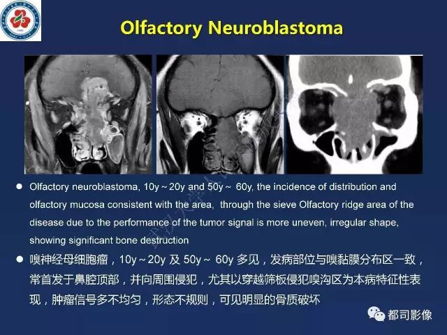 【PPT】鼻腔鼻窦转移瘤1例影像诊断