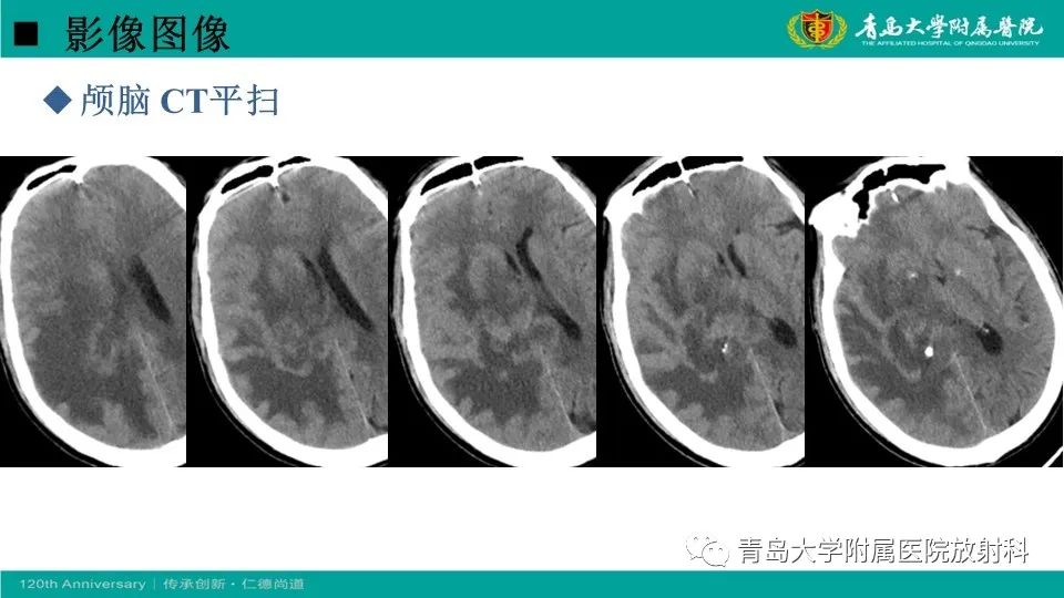 【病例】原发性中枢神经系统淋巴瘤1例CT及MR影像-4