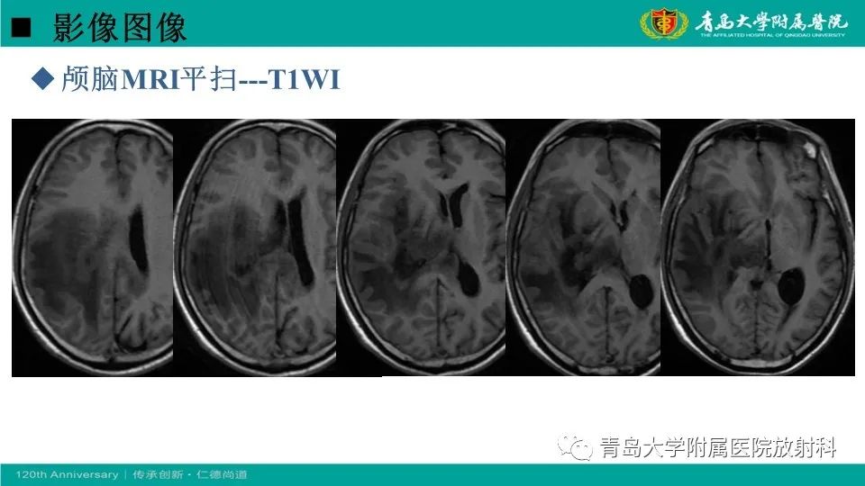 【病例】原发性中枢神经系统淋巴瘤1例CT及MR影像-5