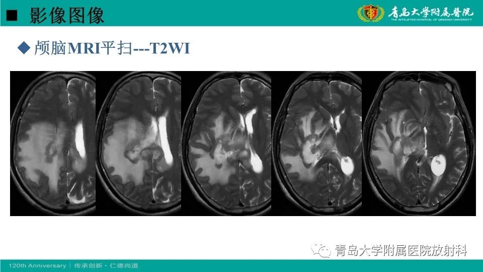 【病例】原发性中枢神经系统淋巴瘤1例CT及MR影像-6