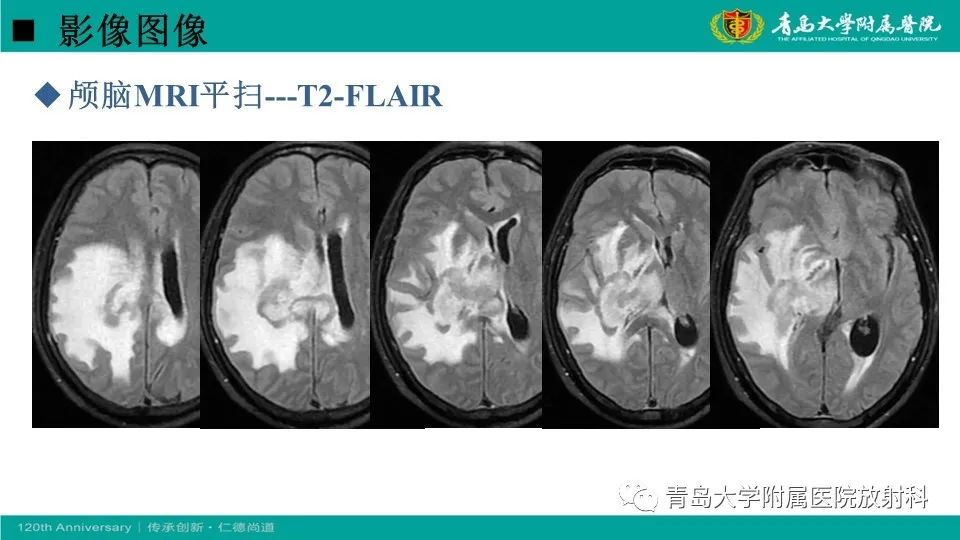 【病例】原发性中枢神经系统淋巴瘤1例CT及MR影像-7