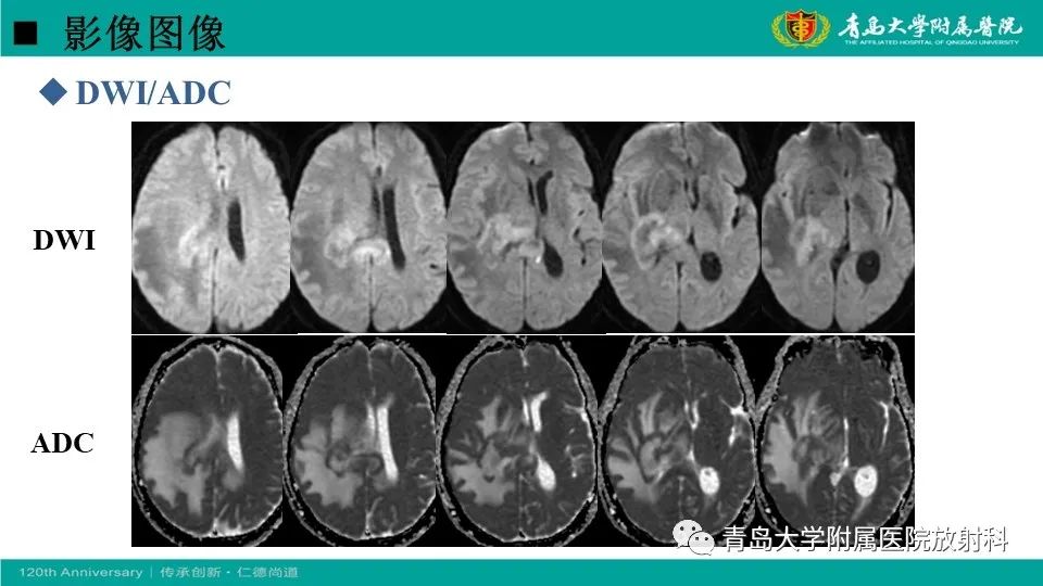 【病例】原发性中枢神经系统淋巴瘤1例CT及MR影像-8