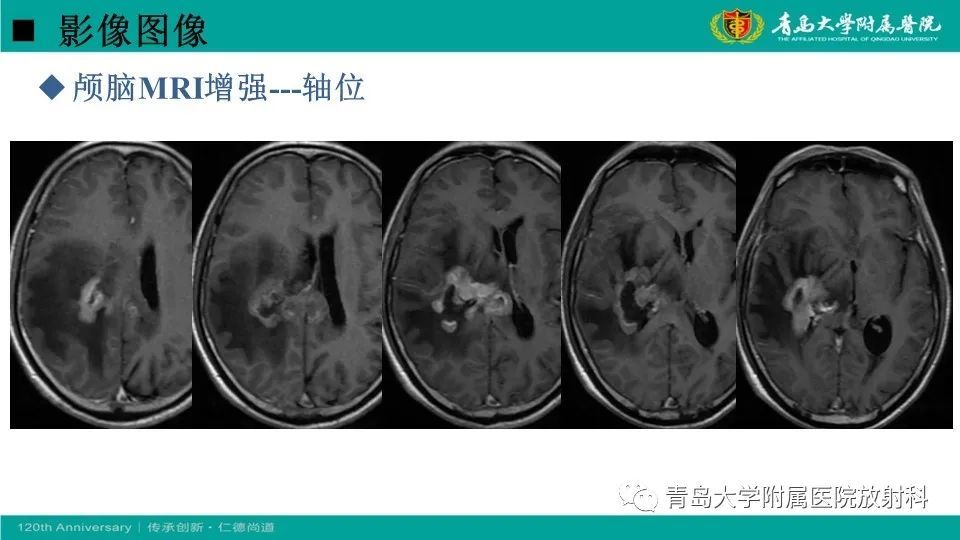 【病例】原发性中枢神经系统淋巴瘤1例CT及MR影像-9