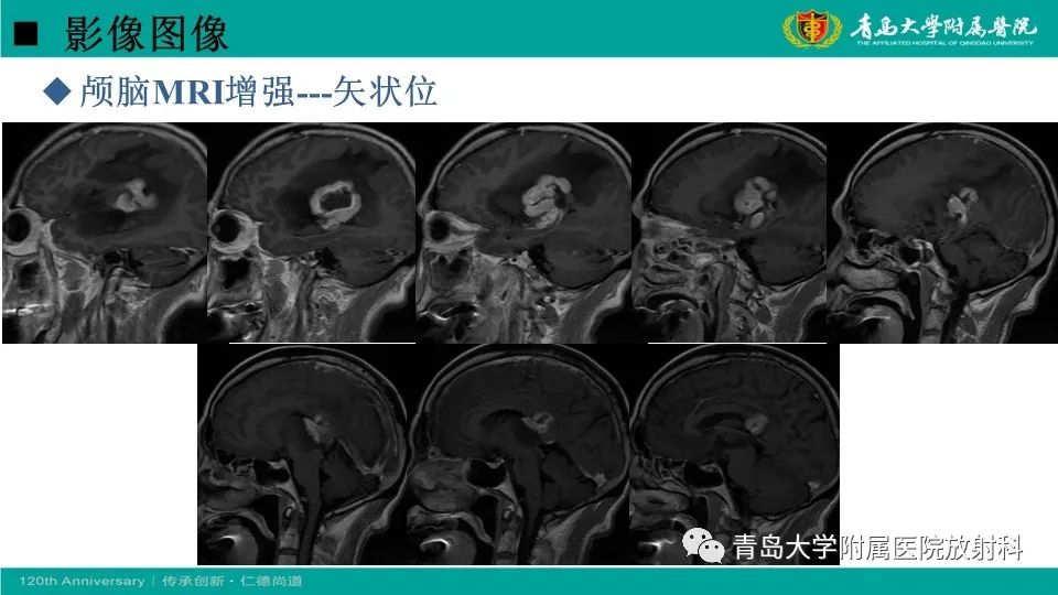【病例】原发性中枢神经系统淋巴瘤1例CT及MR影像-10