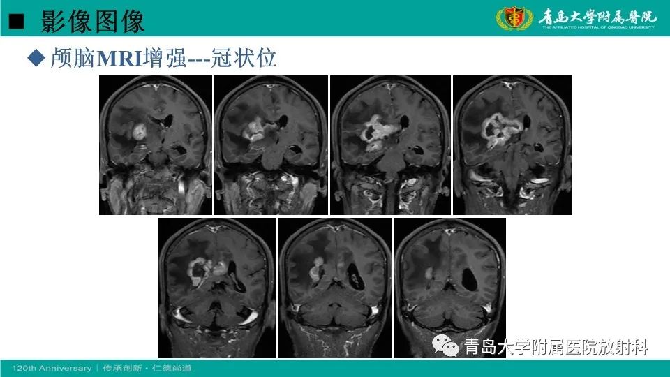 【病例】原发性中枢神经系统淋巴瘤1例CT及MR影像-11