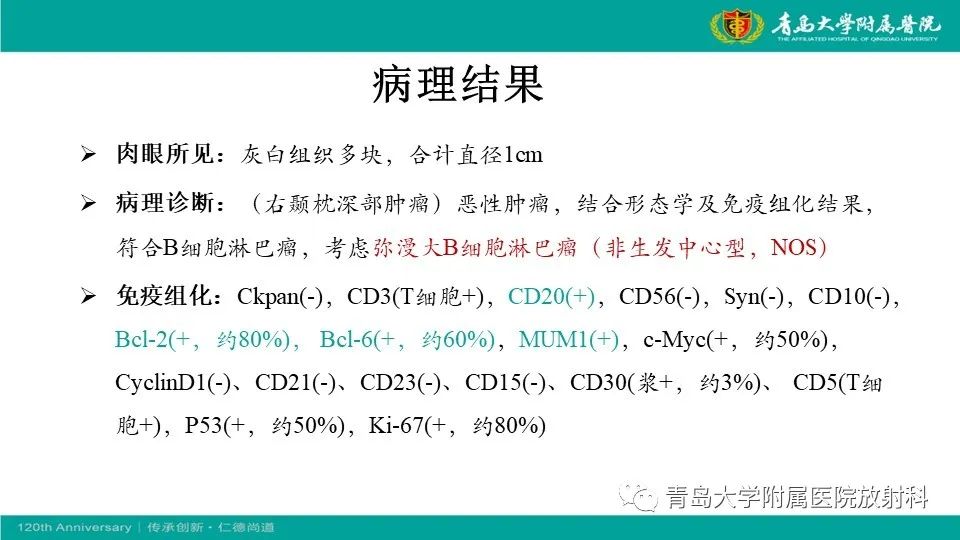 【病例】原发性中枢神经系统淋巴瘤1例CT及MR影像-13