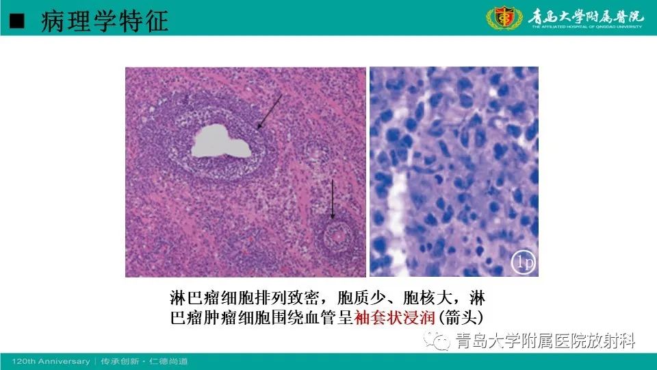 【病例】原发性中枢神经系统淋巴瘤1例CT及MR影像-15